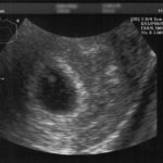Ultrasound #1 The thing that looks like a tonsil...yup, that's the kiddo