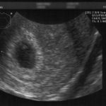 Ultrasound #2 It has my nose